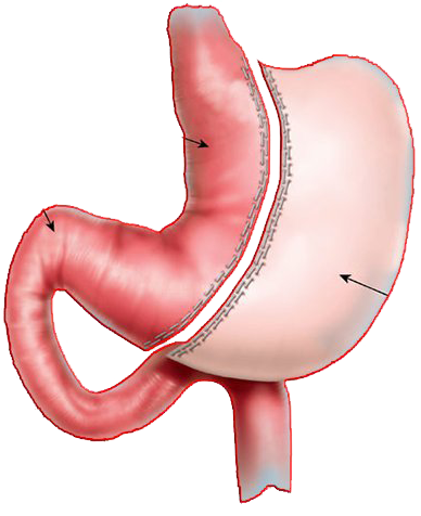 sleeve-gastrectomy-gastric-bypass-surgery